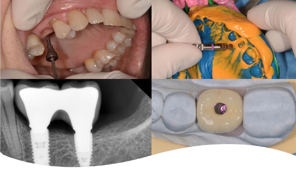 Implant mentor program